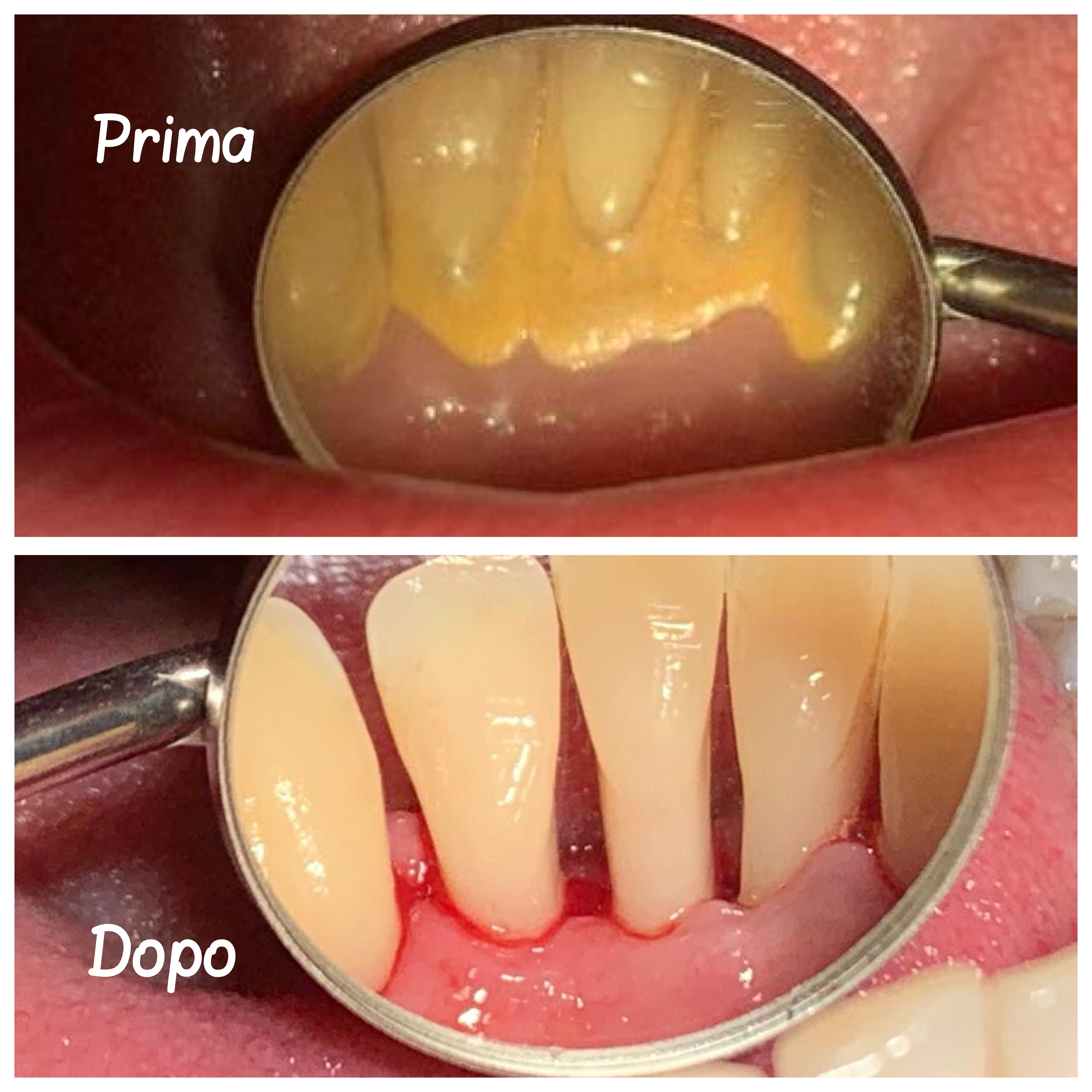 Prima e dopo sbiancamento dentale - caso 1